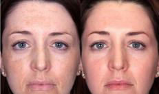 रासायनिक सोलणे - प्रकार, वैशिष्ट्ये, विरोधाभास, प्रभाव डोळ्यांच्या सभोवतालच्या त्वचेसाठी कोणते सोलणे योग्य आहे