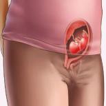 Simptomi grozečega splava: v zgodnji nosečnosti, v drugem in tretjem trimesečju. Spontani splav se pojavi v drugem trimesečju.