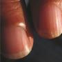 Perché sono comparse delle crepe sulle unghie delle mani: foto, cause e trattamento