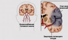 โรคหลอดเลือดสมองตีบในอาณาเขต MCA ที่ถูกต้อง