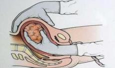 Posizione normale della placenta dal sistema operativo interno per settimana