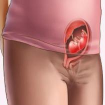 أعراض الإجهاض المهدد: في بداية الحمل، في الثلث الثاني والثالث، يحدث الإجهاض في الثلث الثاني من الحمل
