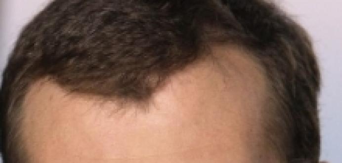 Dlaka u fizionomiji Ružna dlaka na čelu povučene dlake