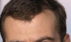 Hairline in physiognomy Ugly hairline on the forehead of a receding hairline