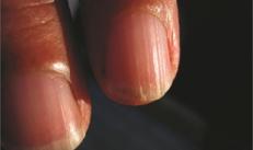 Защо се появиха пукнатини по ноктите на ръцете - снимка, причини и лечение