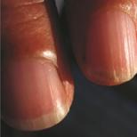 Защо се появиха пукнатини по ноктите на ръцете - снимка, причини и лечение