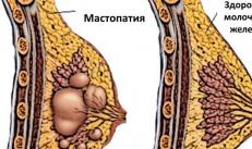 Semne și simptome de mastopatie a glandelor mamare - diagnostic, tratament cu medicamente și remedii populare