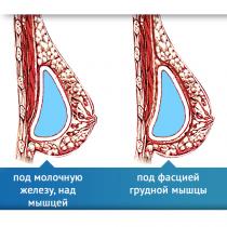 Уголемяване на гърдите: прегледи, снимки преди и след операция, видео