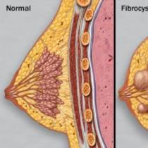 Mastopatia fibrosa diffusa delle ghiandole mammarie